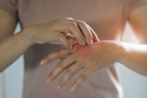 Une femme se gratte la main jusqu'à ce qu'elle soit rouge, montrant comment la dépression peut provoquer une irritation ou une sensibilité accrue