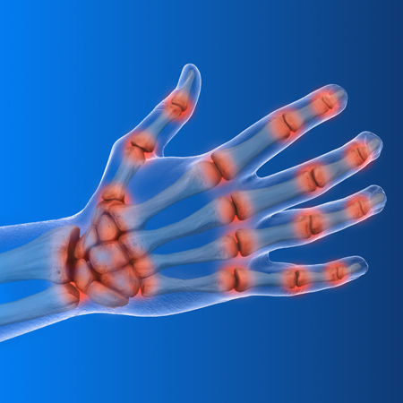 X-ray of hand showing inflammation, which could be as a result of loneliness